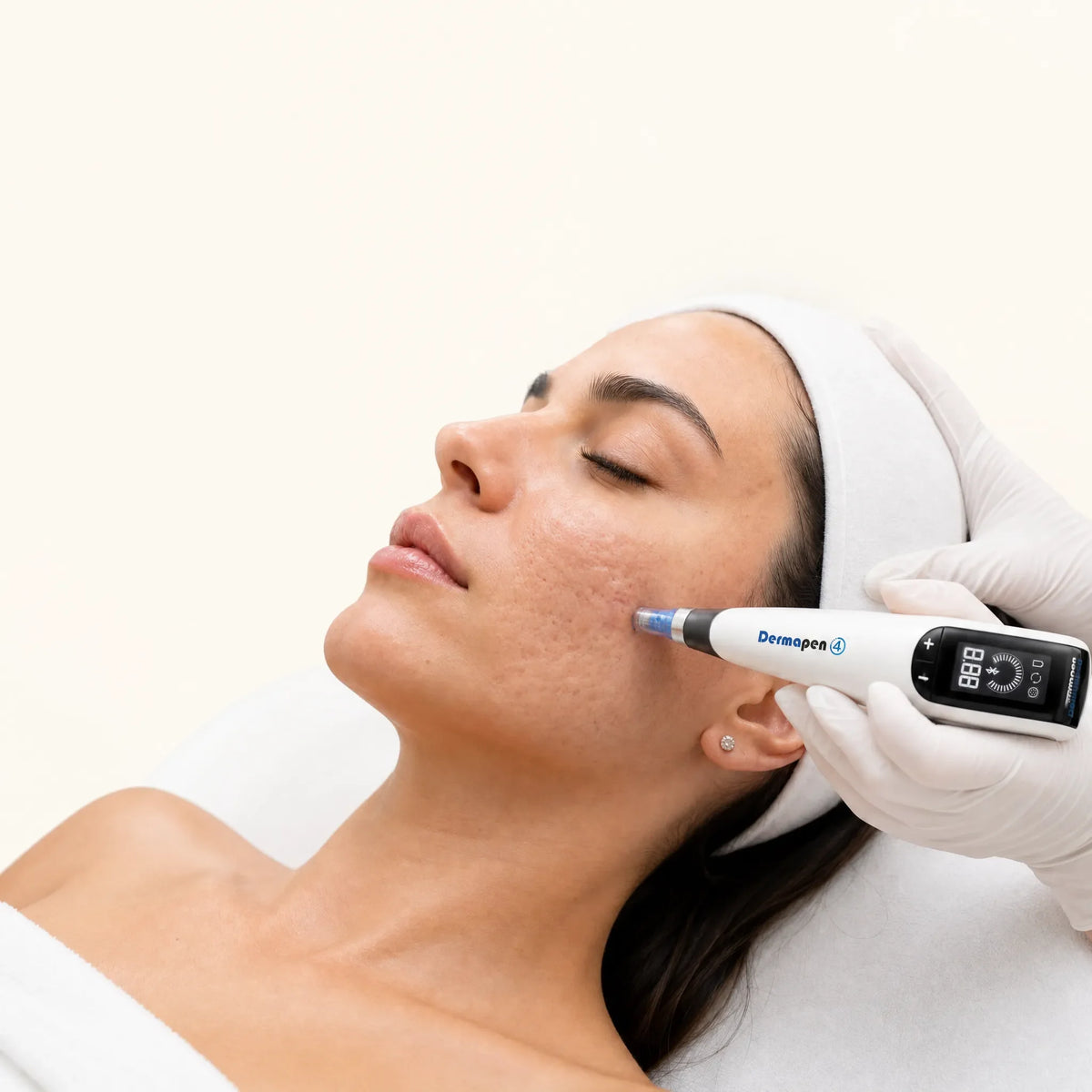 Microneedling for Acne Scars