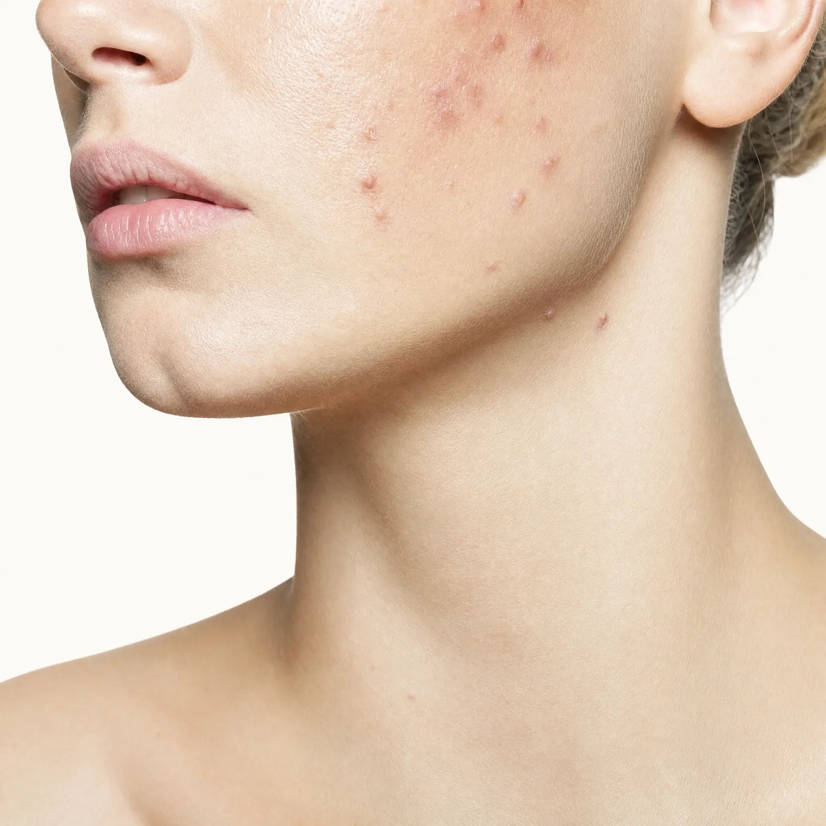 Acne peels