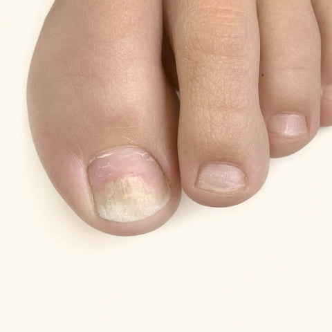 Ndyag Onychomycosis (nail fungus)