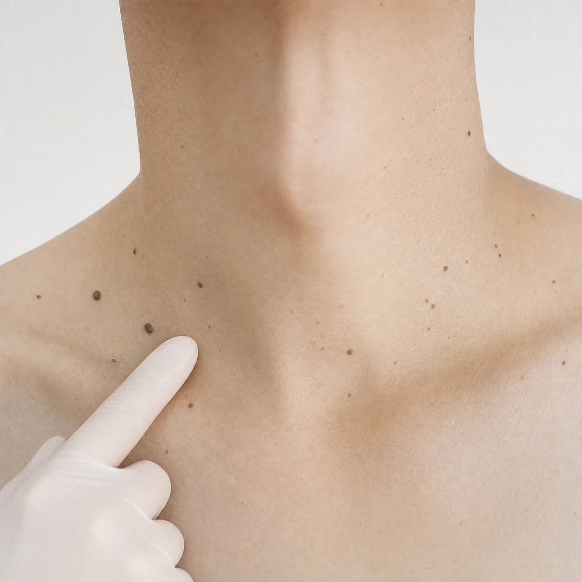 Skin tags and lesions