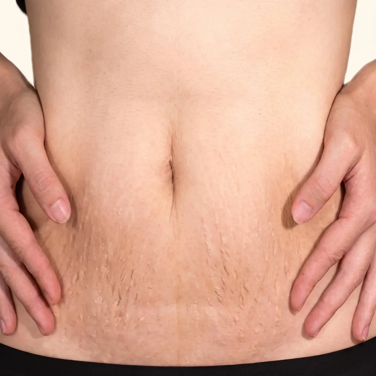 Erbium Laser Resurfacing for Stretchmarks