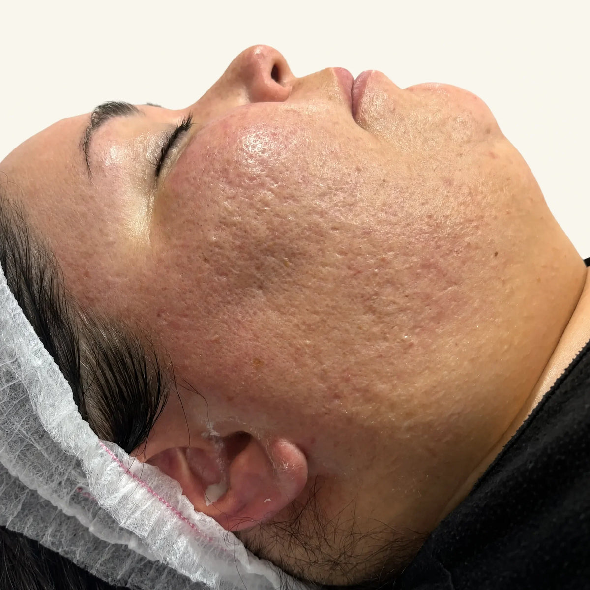 Dermapen Microneedling — before