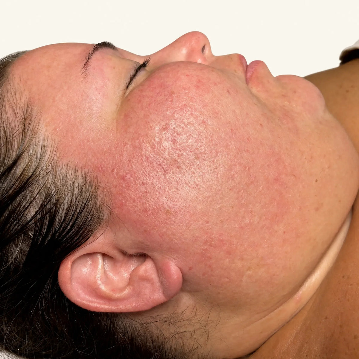 Dermapen Microneedling — after