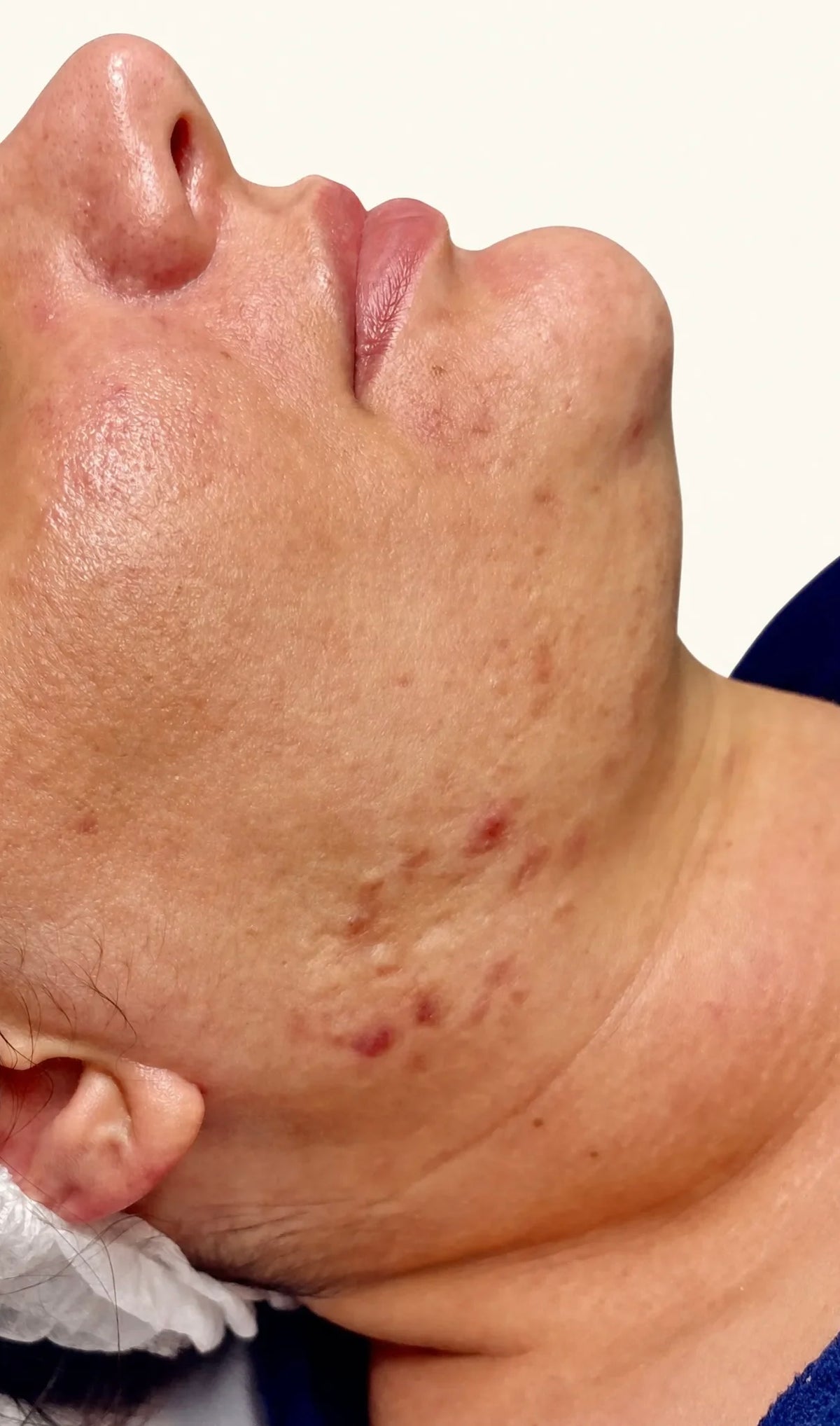 Acne program — before