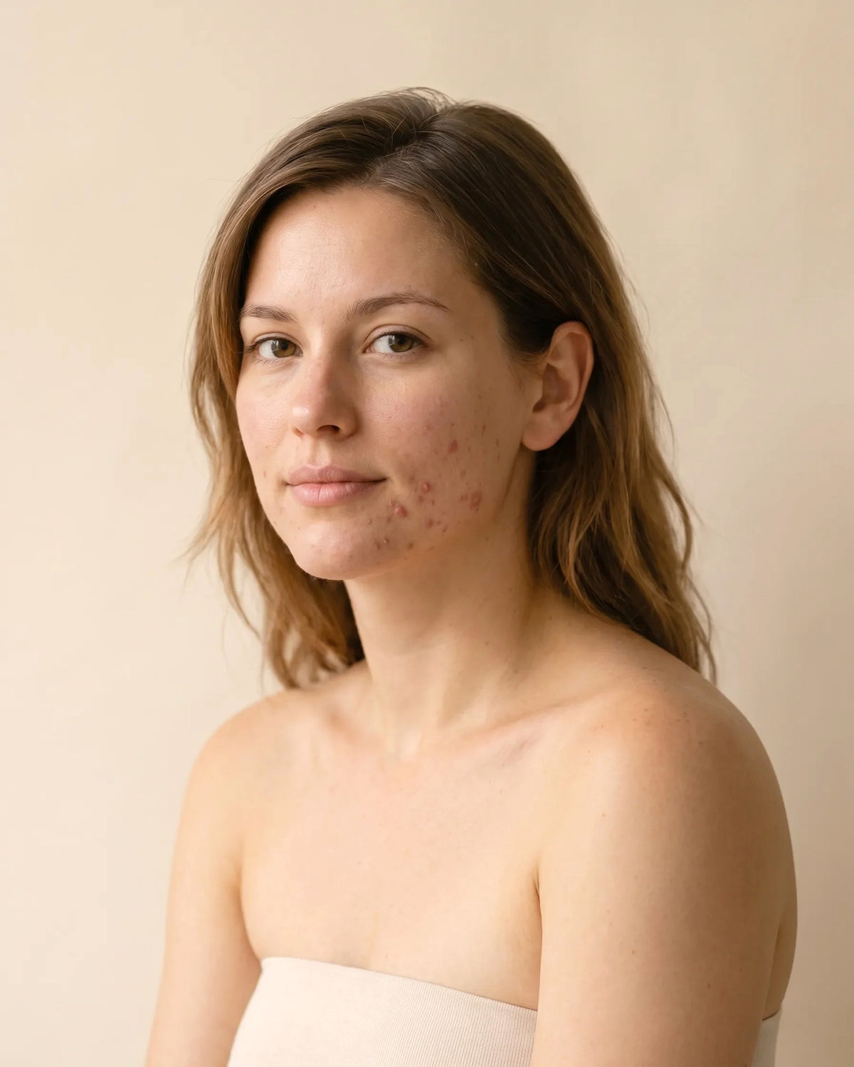 Acne treatments