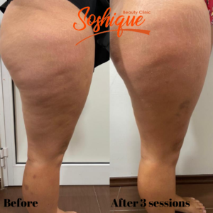 Read more about the article Anti Cellulite Treatments