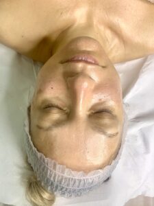 Read more about the article Dermaplaning