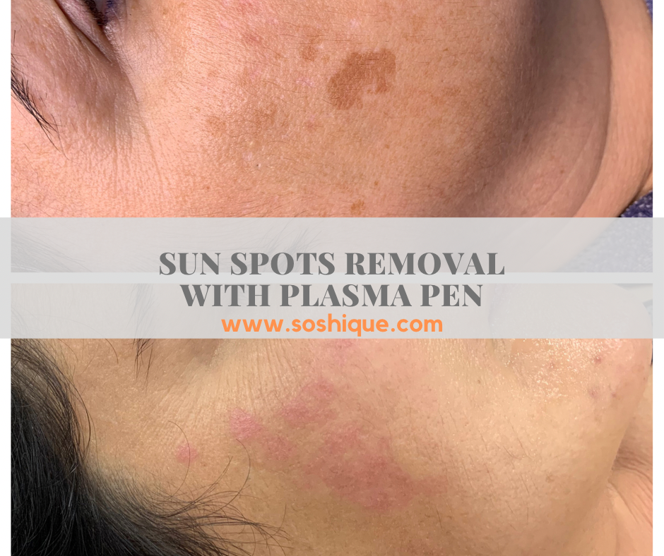 You are currently viewing Skin Resurfacing with Plasma Pen for removal of sun/age spots