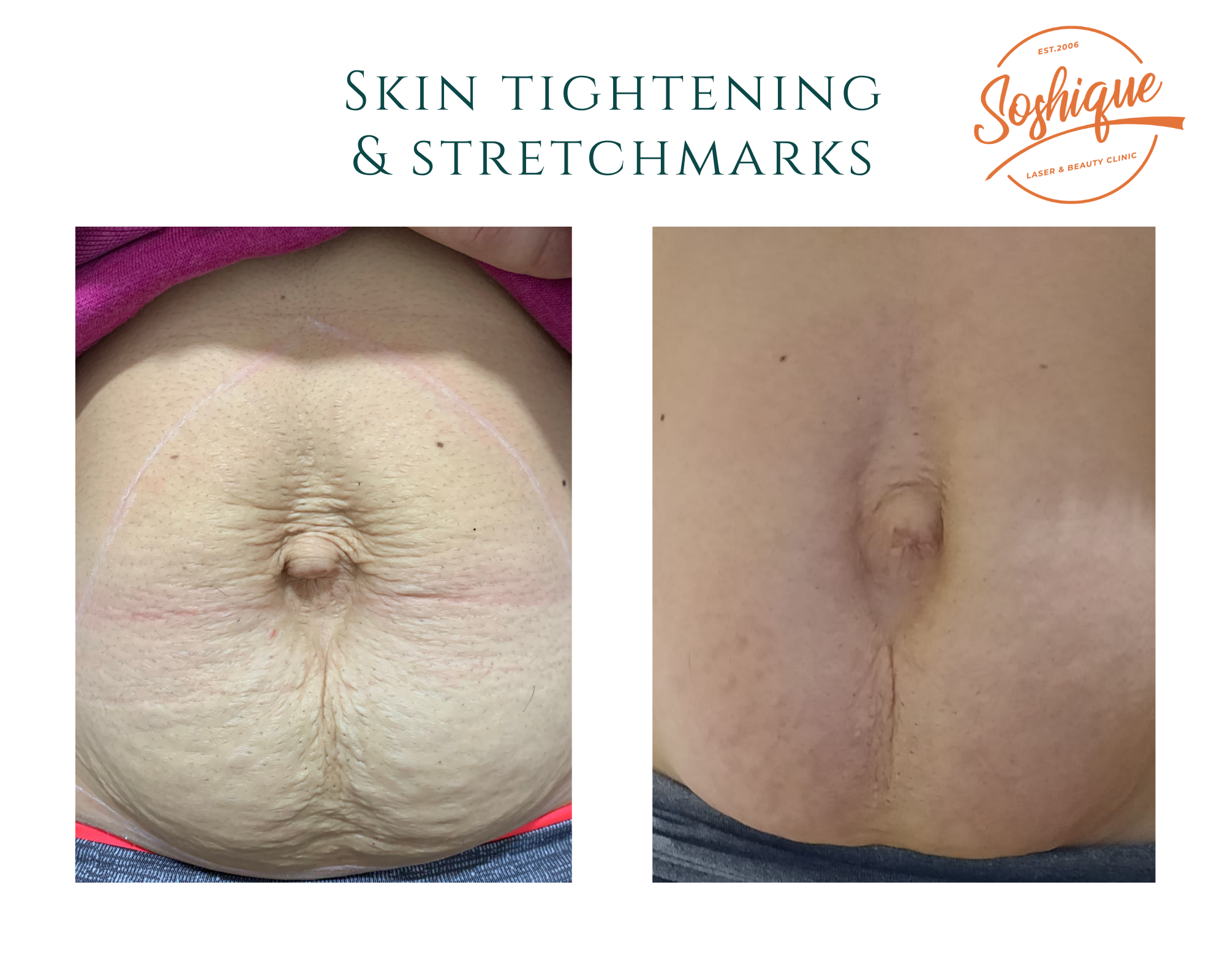 You are currently viewing Skin Tightening & Stretchmarks